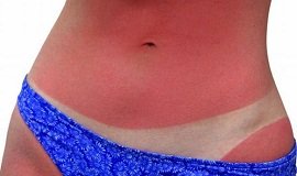 Народные средства от солнечных ожогов кожи