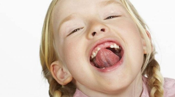 Пластика уздечки языка у детей: на что влияет длина уздечки языка, чем опасно оставить ее без внимания и какие симптомы у короткой уздечки