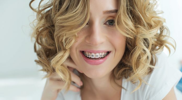 Как выбрать брекеты к своему стилю: где проводится установка брекетов в Петербурге