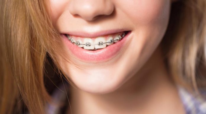 Исправление прикуса: в каком возрасте приемлемо