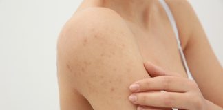 Причины и симптомы чесотки: профилактика и лечение