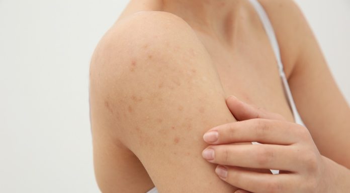 Причины и симптомы чесотки: профилактика и лечение