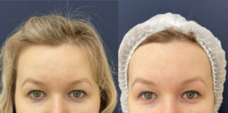 SMAS лифтинг: плюсы, возможные риски и осложнения