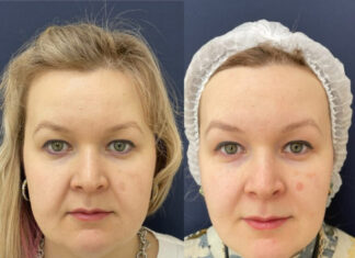 SMAS лифтинг: плюсы, возможные риски и осложнения