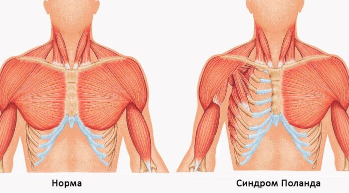 Патологии грудной клетки у детей